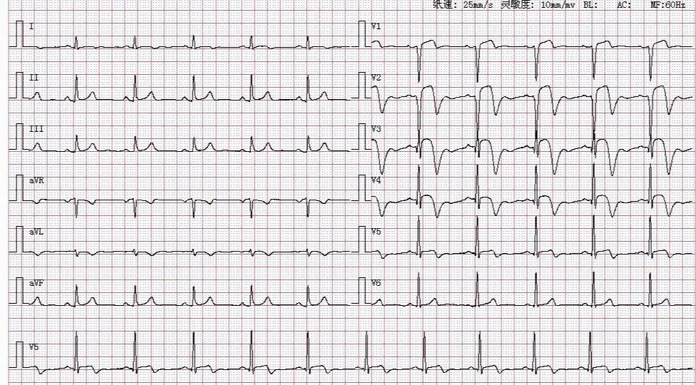典型心电图:急性心肌梗死.没有基础也能一看就懂!_分析_检查_相关