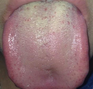 看一下舌苔,属于什么