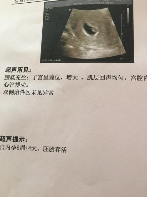 孕46天看孕囊形状猜男女