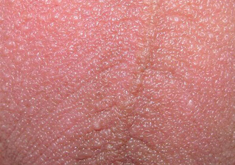 男人睾丸上长硬疙瘩图片及原因