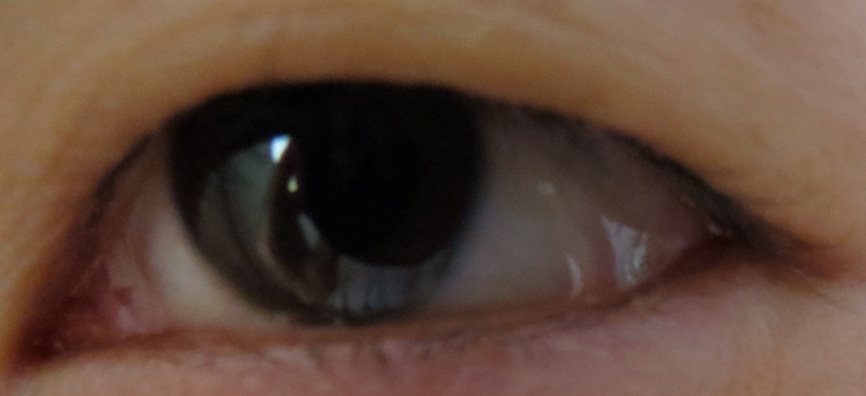 眨眼时,眼角眼白的最外面一层透明的东西像褶皱是什么症状?严重么?