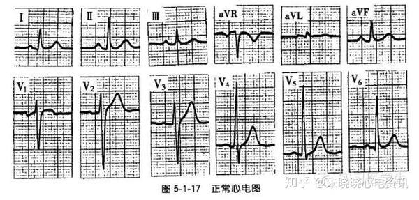 三.正常心电图
