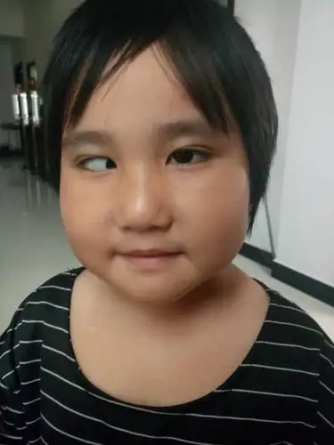 这是一个5岁的漂亮小姑娘,由于眼睛斜视父母非常着急,为此没有少花钱.