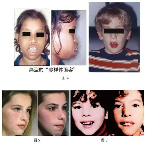 扁桃体发炎致声音哑怎么办 成都民生耳鼻喉专科医院治扁桃体靠谱__寻