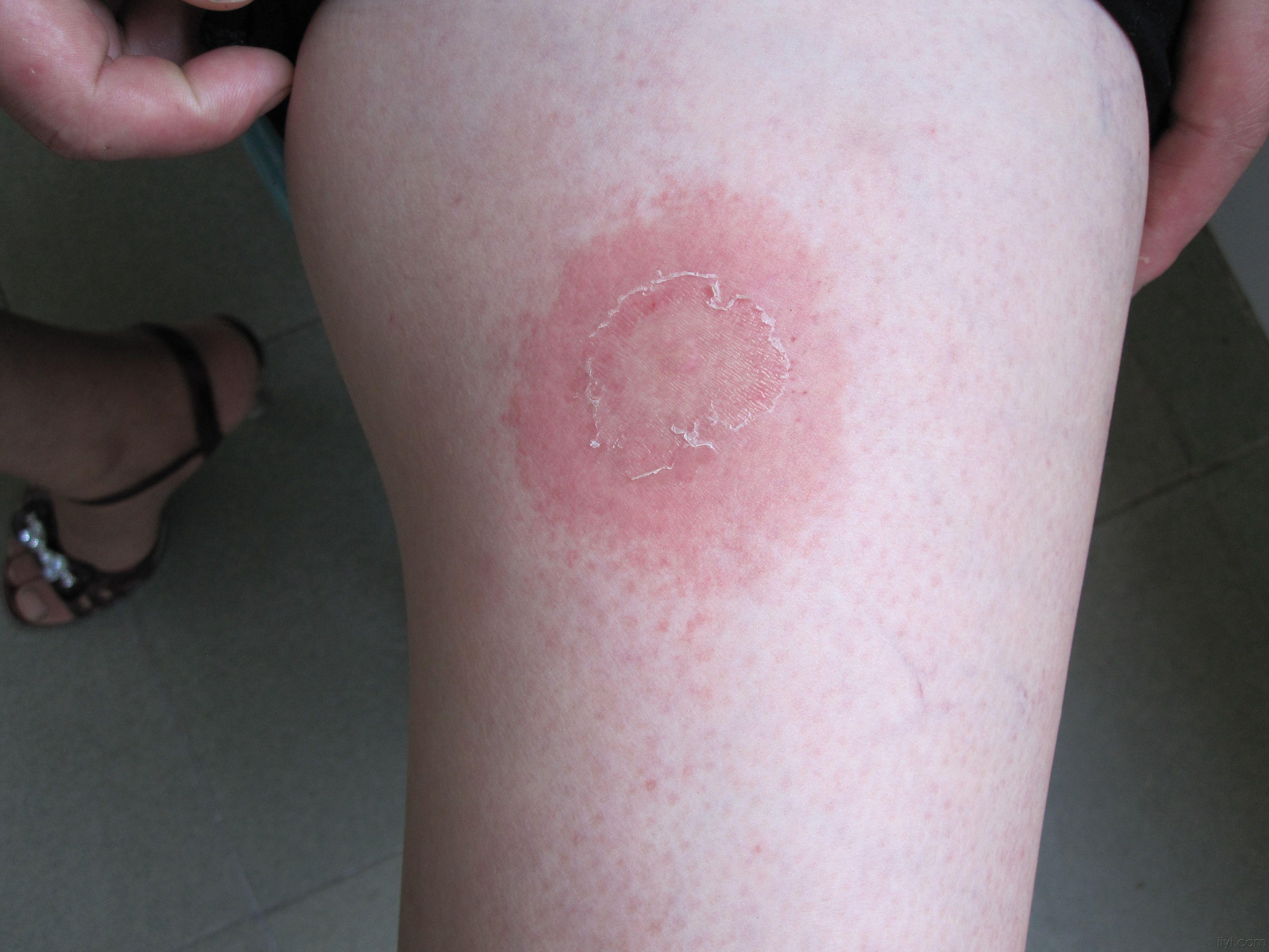 米粒大丘疹长成大红斑-多形红斑型药疹 - 皮肤及性传播疾病讨论版