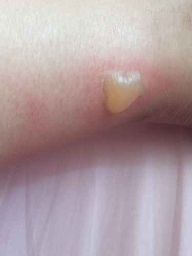 晚上睡觉脚被热水袋烫成这样了,要怎么处理比较好?