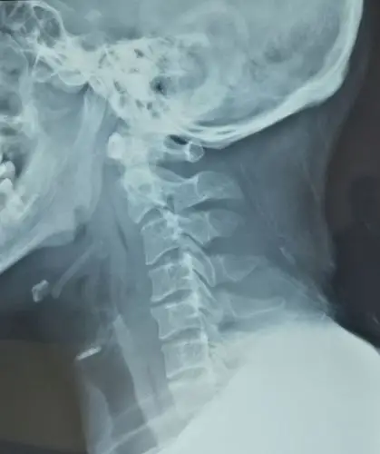 颈前路手术治疗跳跃性颈椎过伸脊髓损伤