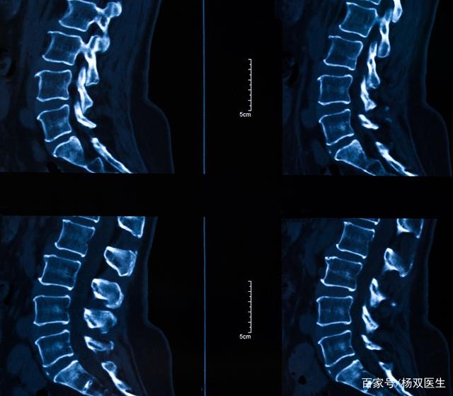 半椎体形成病因尚未完全明确,可能与胚胎发育异常有关,在脊柱发育期间