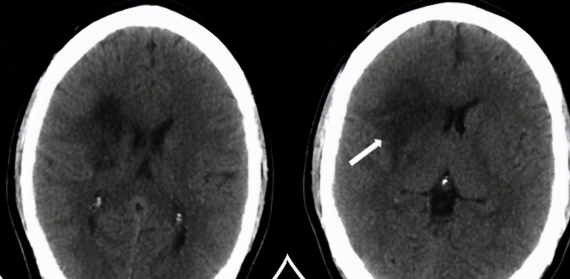 诱因不止有高血压这一个_动脉_血管_栓子