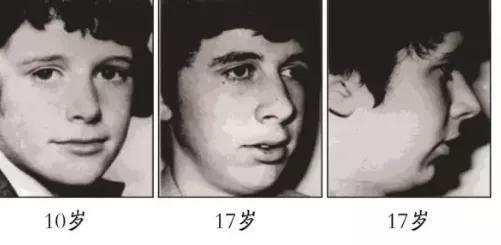 腺样体面容是腺样体肥大导致的最严重的症状之一.