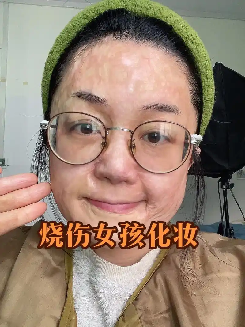 32岁烧伤女孩93|情人节约会妆容!#烧伤女孩 #约会妆 # - 抖音