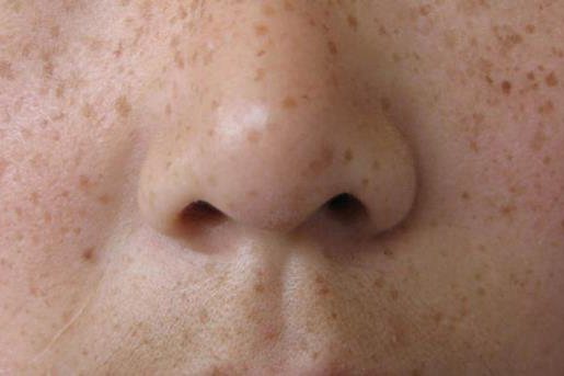 面部七种斑的图片