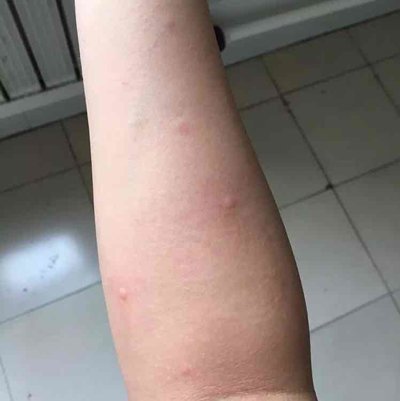 荨麻疹的前期症状