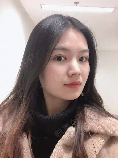 眼综合整形术后20天_眼型矫正术后20天_眼综合术后20天_开眼角术后20