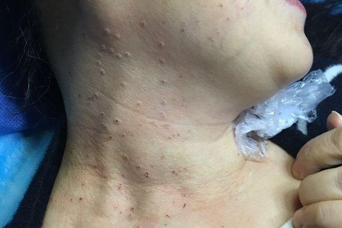 女性脖子扁平疣图片