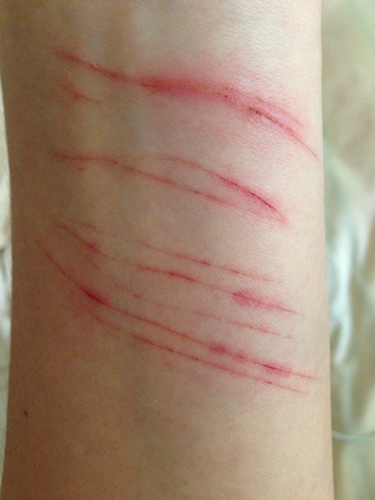 手用菜刀割开的需要打破伤风针吗?