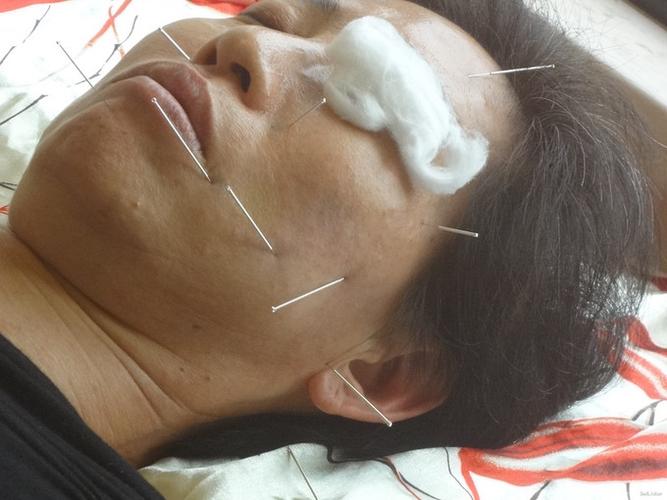 随访 讨论随访:患者经过两周共6次治疗后者左侧口眼歪斜改善,左侧眼睑