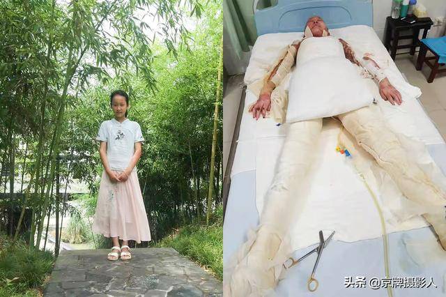 小女孩玩"躲猫猫"造成全身90%烧伤,家长不解为何孩子去碰那个_小灵