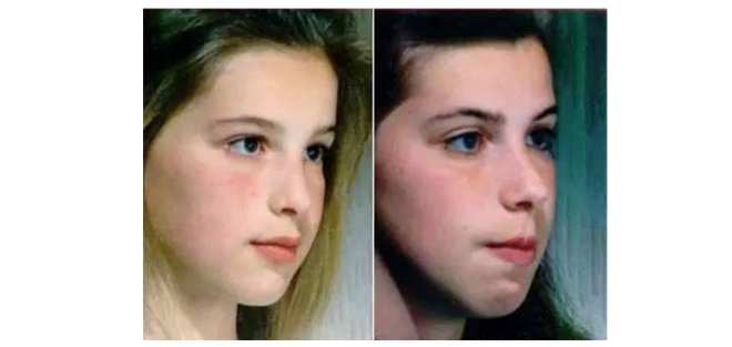 7岁娃腺样体大面容照片,父母要让孩子尽早治疗!