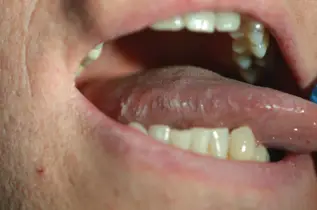 "人活一张脸,树活一张皮",关注hiv感染者的皮肤健康