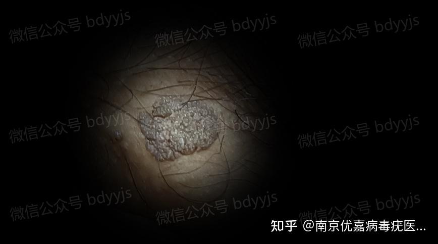 男性菜花状疣高清图片