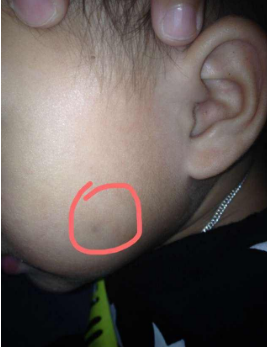 小孩脸上起黑点是怎么回事