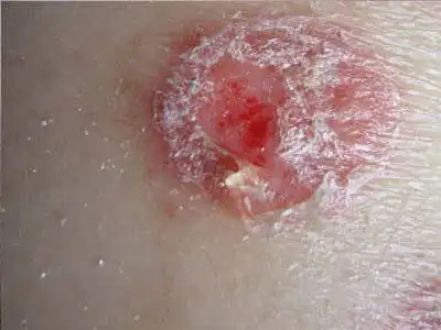 男生阴囊痒湿疹图片