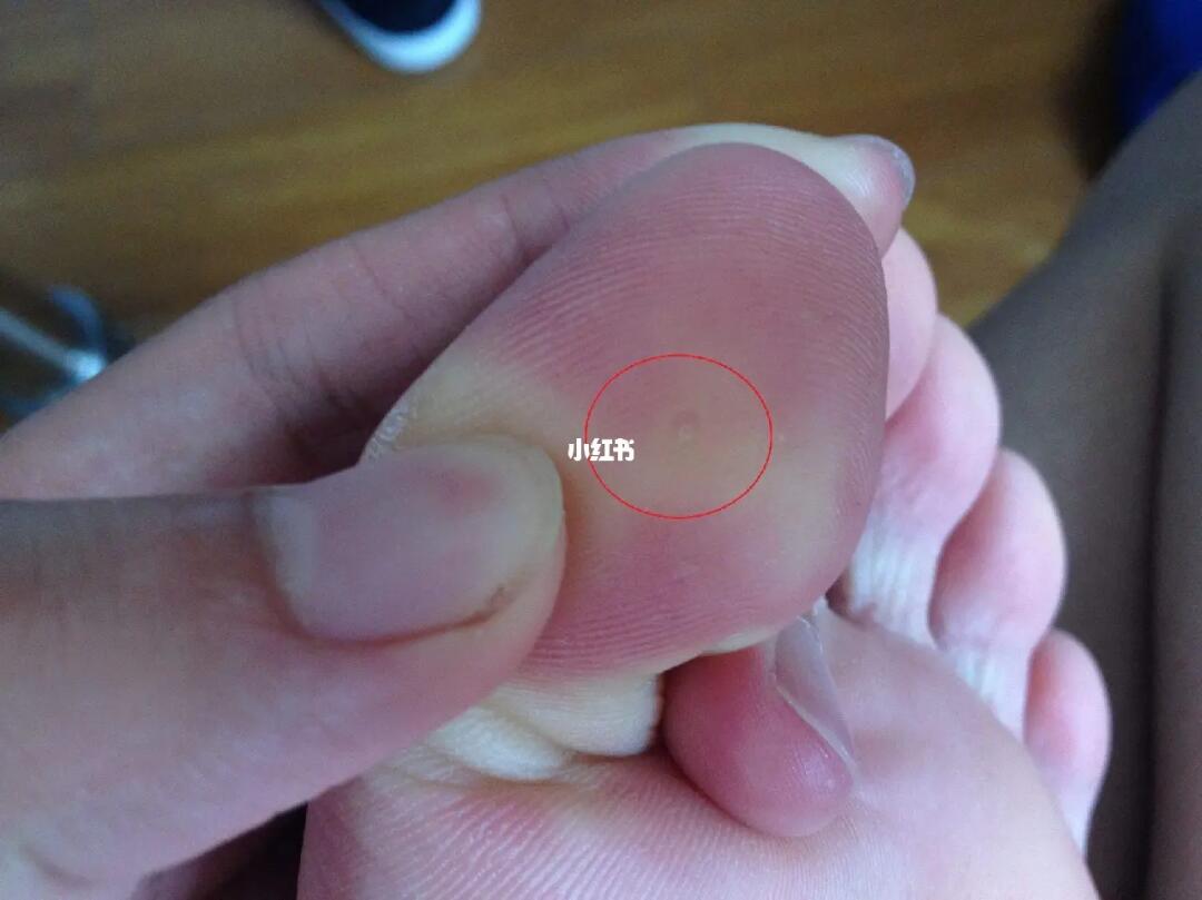 我花了3毛钱三天治好了我的鸡眼05