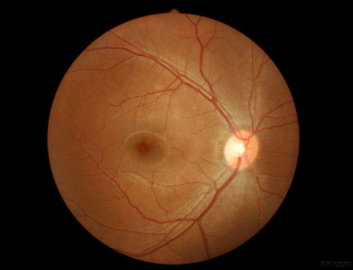 高度近视不仅影响眼睛外观,因眼轴延长,造成眼球凸出,还会发生眼球壁