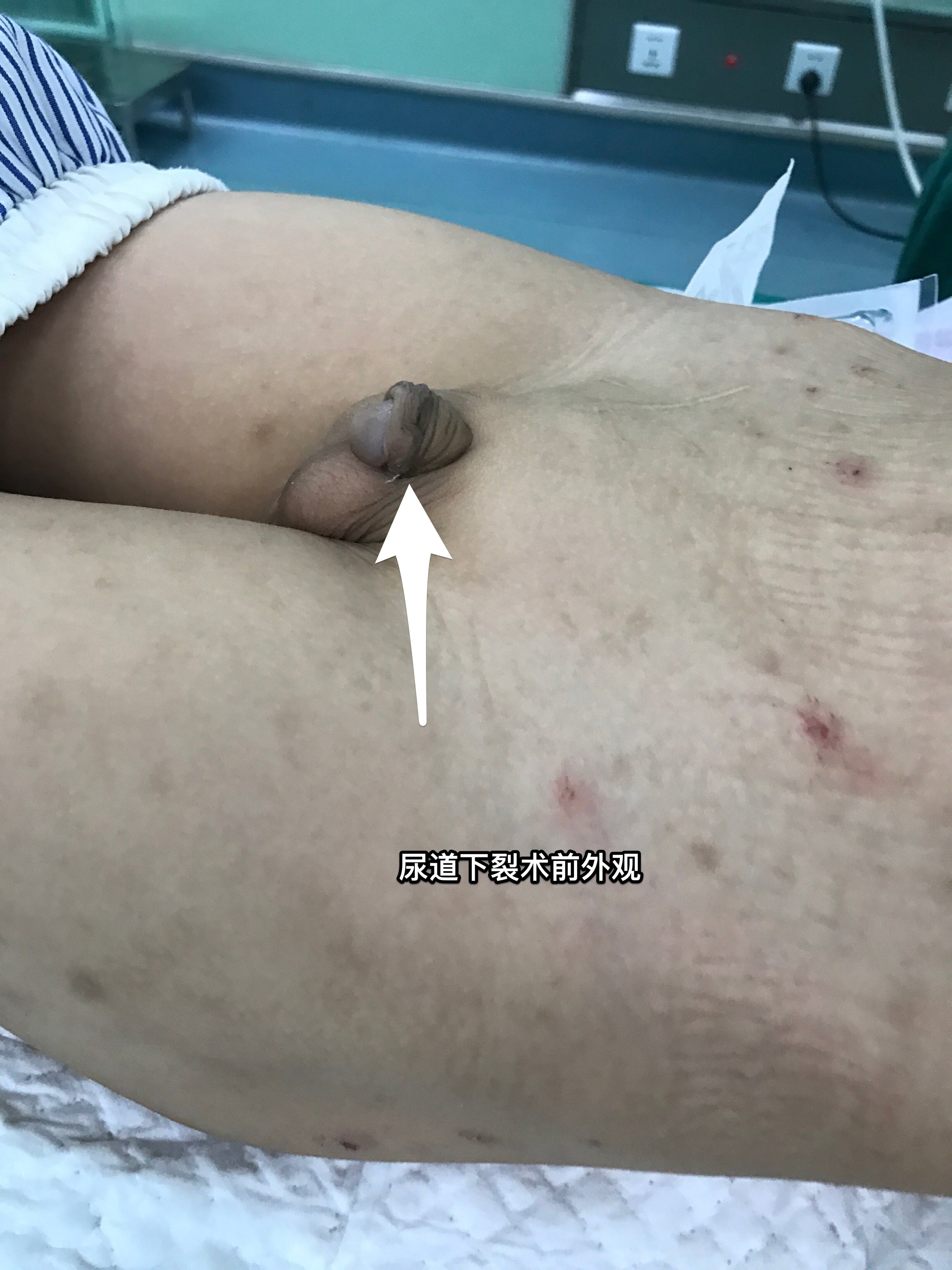 snodgrass术治疗尿道下裂 - 好大夫在线