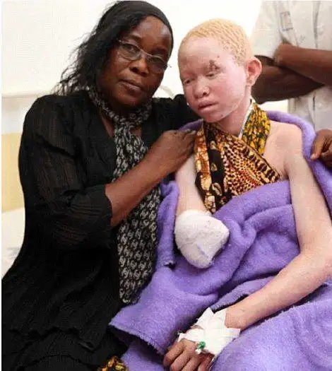 非洲白化病人肢体被制成护身符