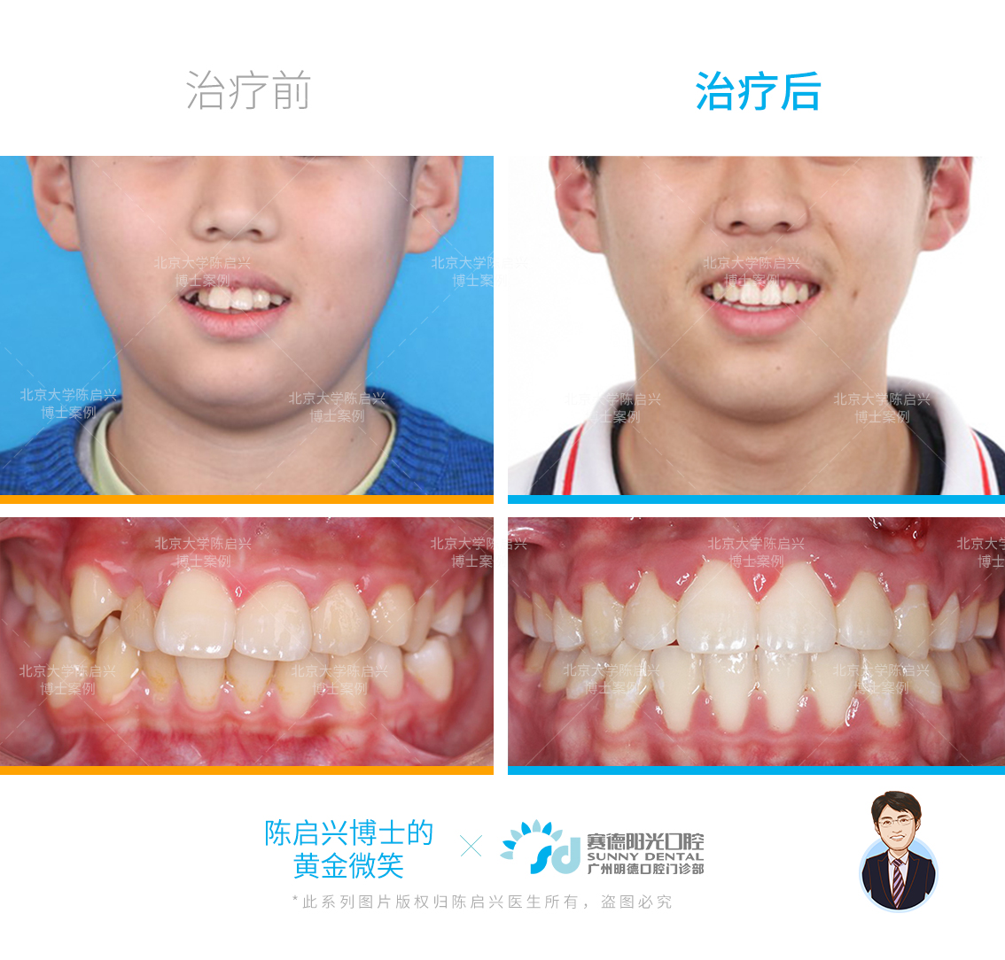 口呼吸腺样体面容矫正案例