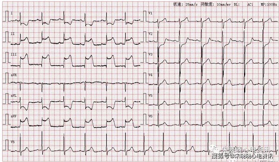 每日读图 || 第1078期 下壁心肌梗死_avr