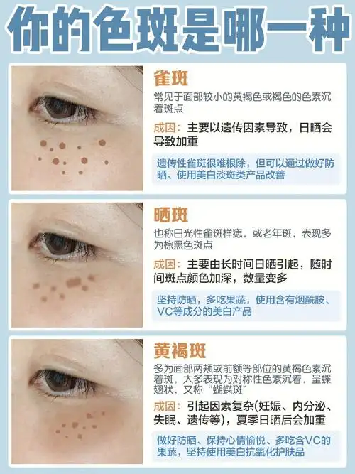 斑点类型科普淡斑攻略快收藏