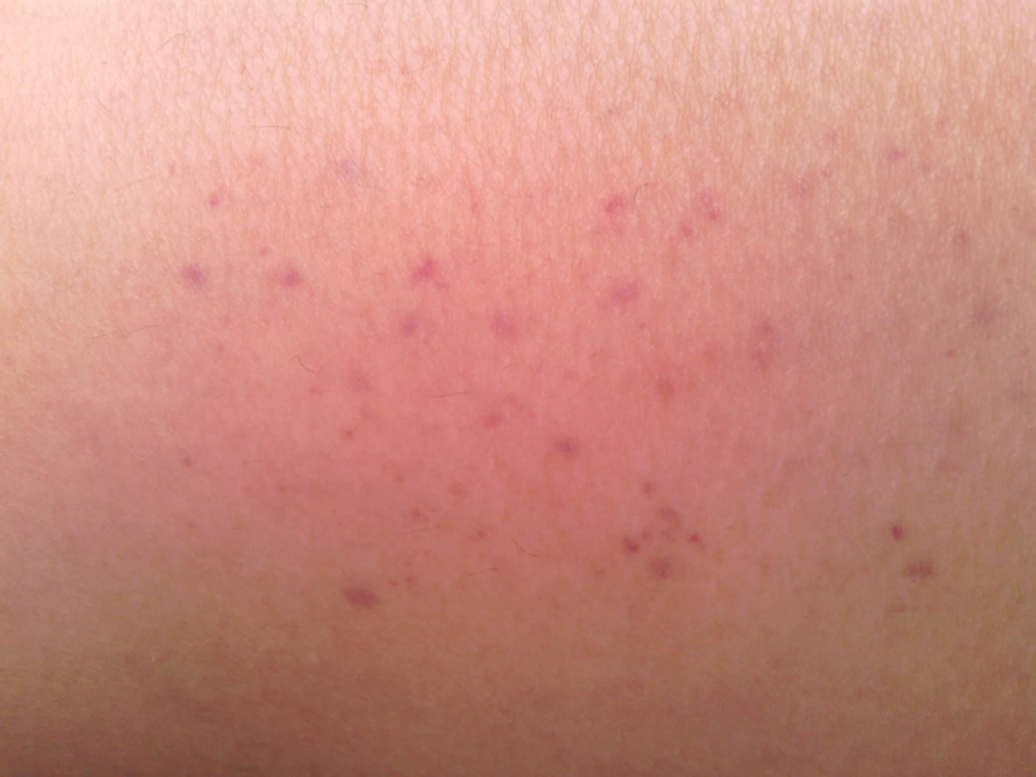 患者信息:女 21岁  病情描述(发病时间,主要症状等): 大腿上突然出现