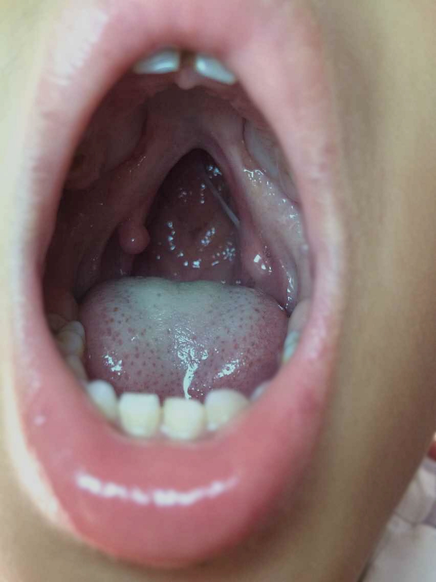 腭裂小患者求助,敬请关注!