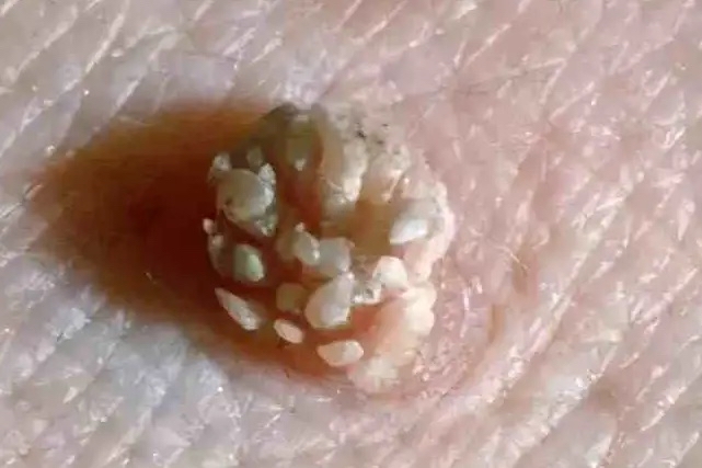 27岁的小陈,怀孕16周时,偶然摸到屁股有一个肉疙瘩,越长越大,伴有疼痛