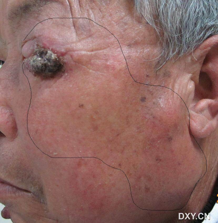 【眼眶病讨论】眼睑恶性肿瘤复发,讨论是否需要眶内容剜除