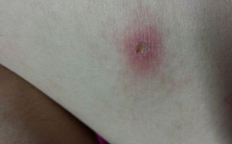 女性全部图片一期梅毒是不是这个的图片一期梅毒的手腕的表现图片一期