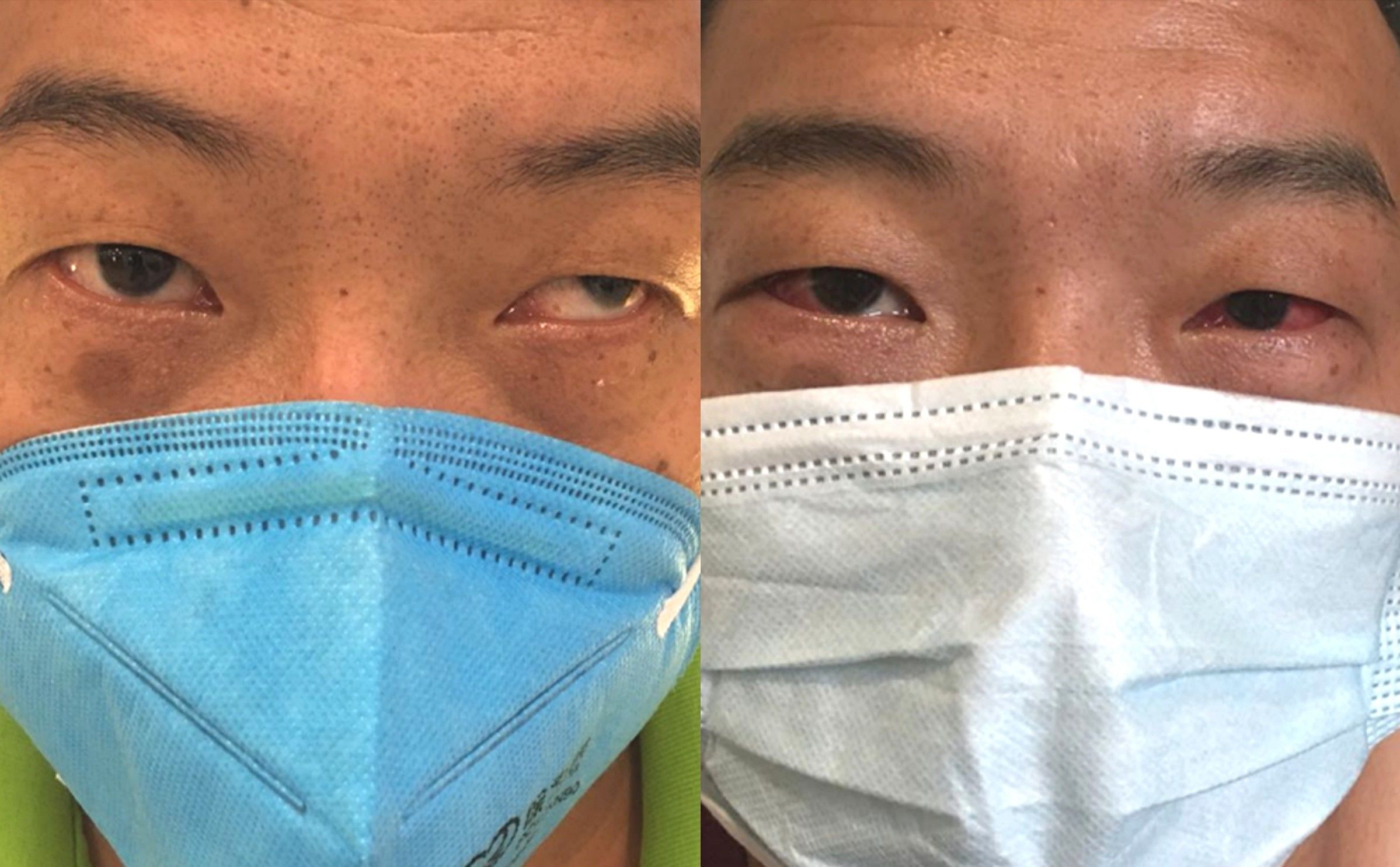 疑难斜视遇上眼球震颤30岁男子在普瑞眼科解决顽疾重拾自信