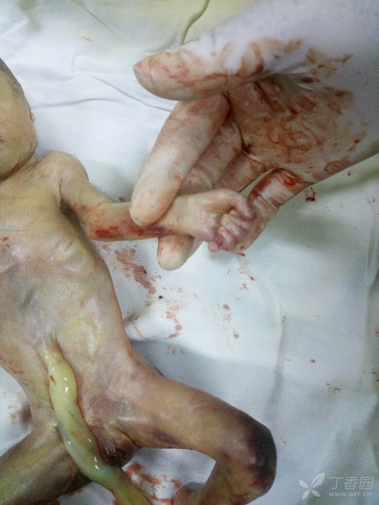 孕妇32岁,孕25周,彩超发现胎儿畸形,引产胎儿如下