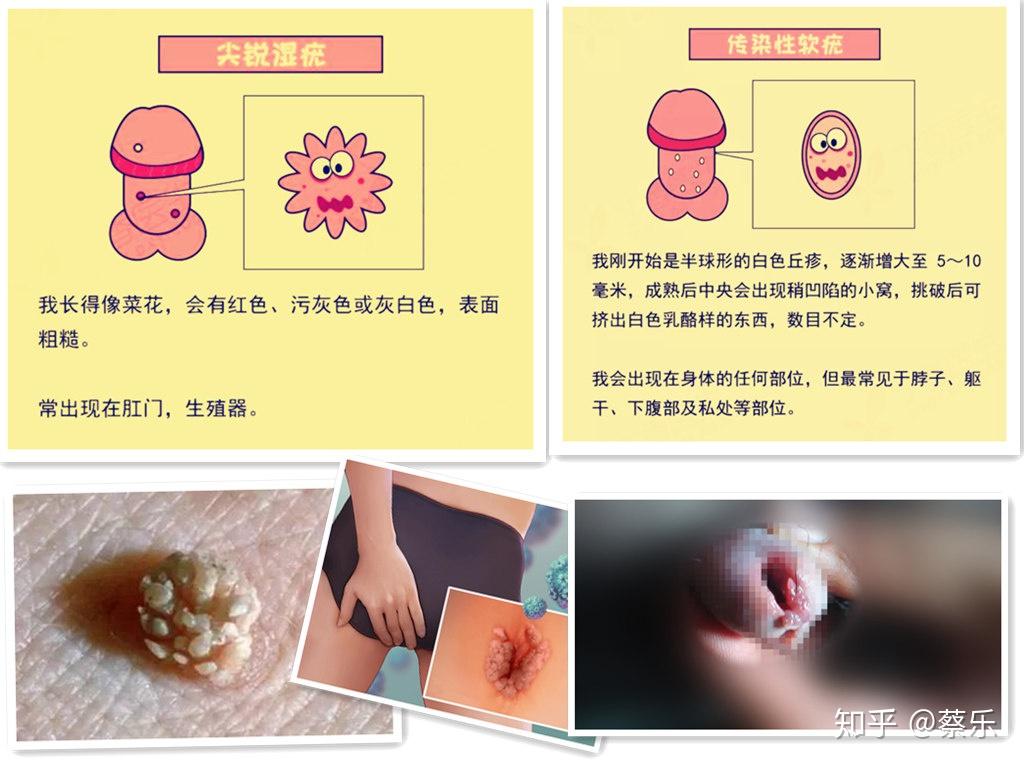 怎么区分珍珠疹和尖锐湿疣? - 知乎