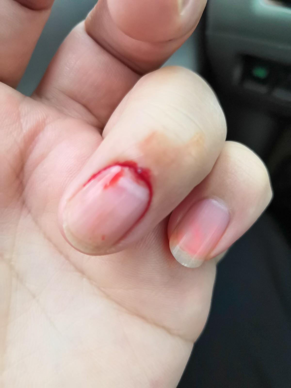 指甲盖上的肉长出硬块,碰到裂开或扯掉会流血,还会重复长,这是什么病?