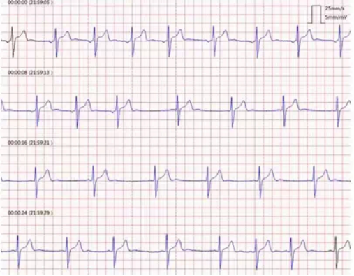 体检心电图查出"窦性心律不齐",问了医生才知道