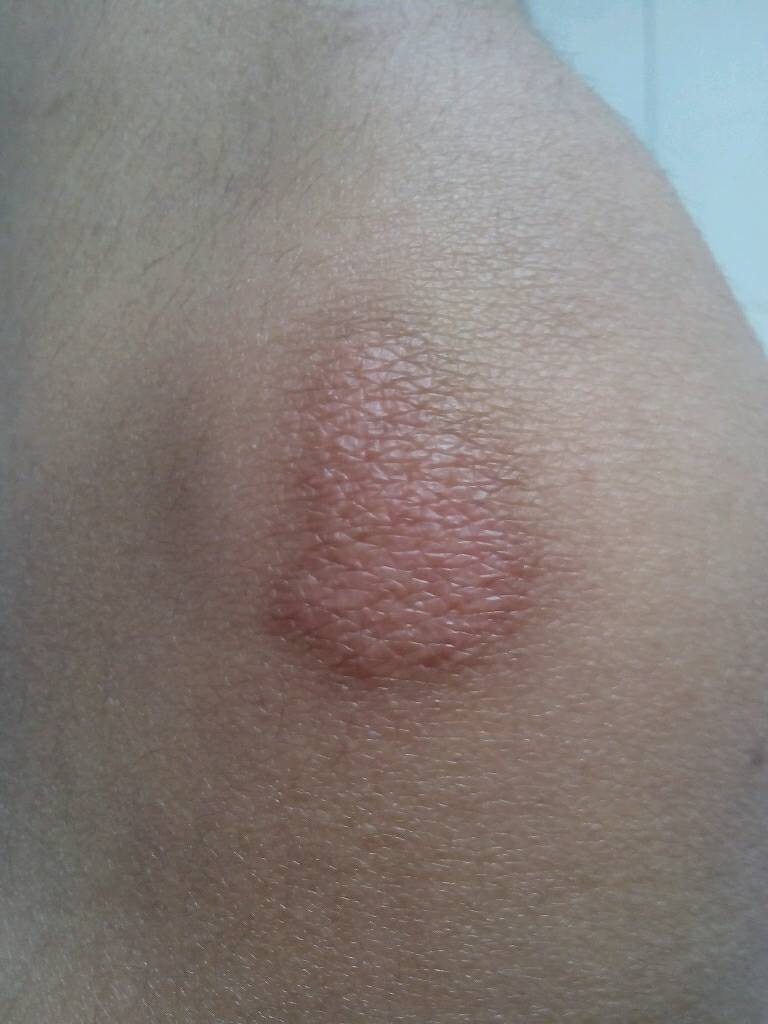 我是个女孩,13岁,这个是今年4月17日运动会不慎摔倒留的疤,我知道疤痕