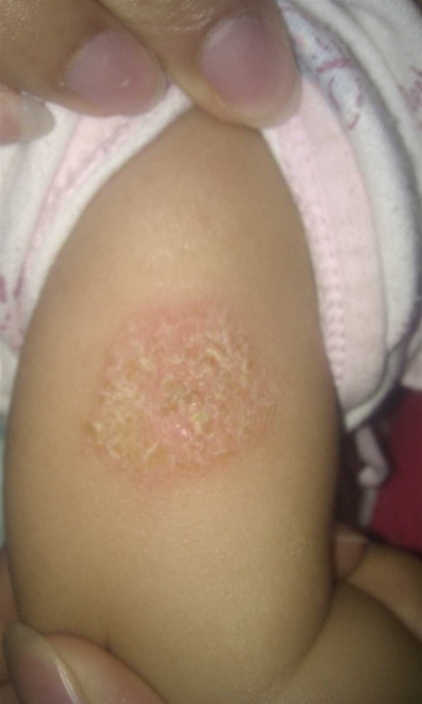 季节变化期,不得不说的儿童皮肤病常识