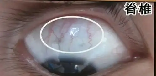瑶医三大法宝之一,神奇的目诊,看眼白知健康