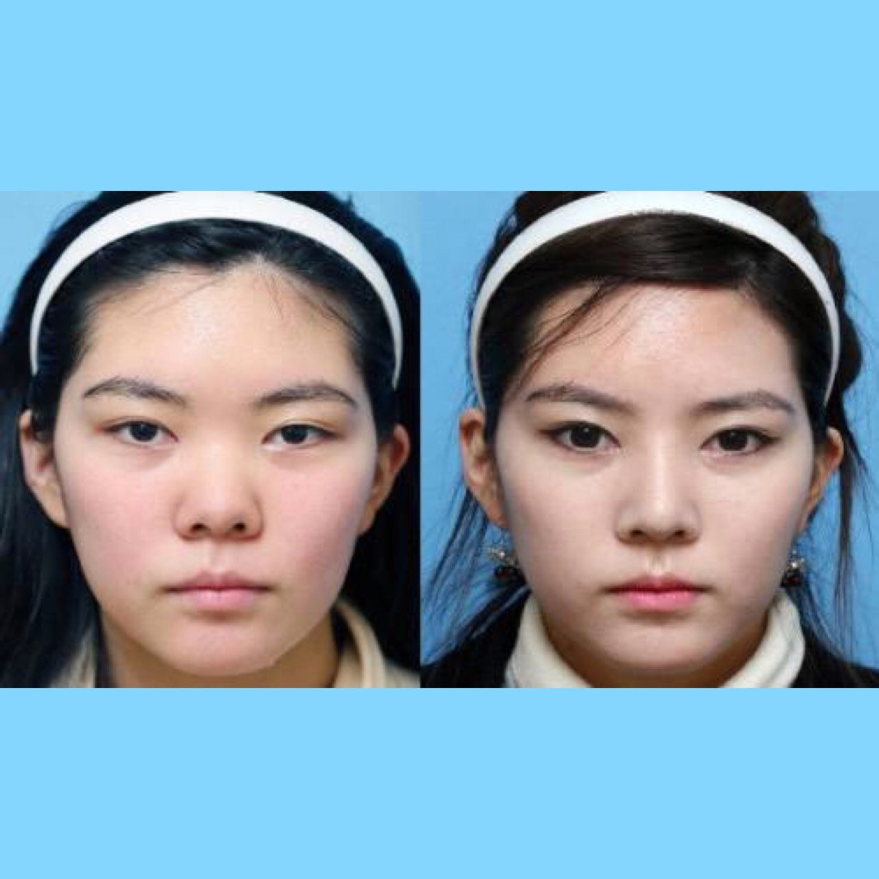 拥有高挺俏鼻是众多塌鼻子星人的梦想美丽的鼻子对整个面部起到百分之