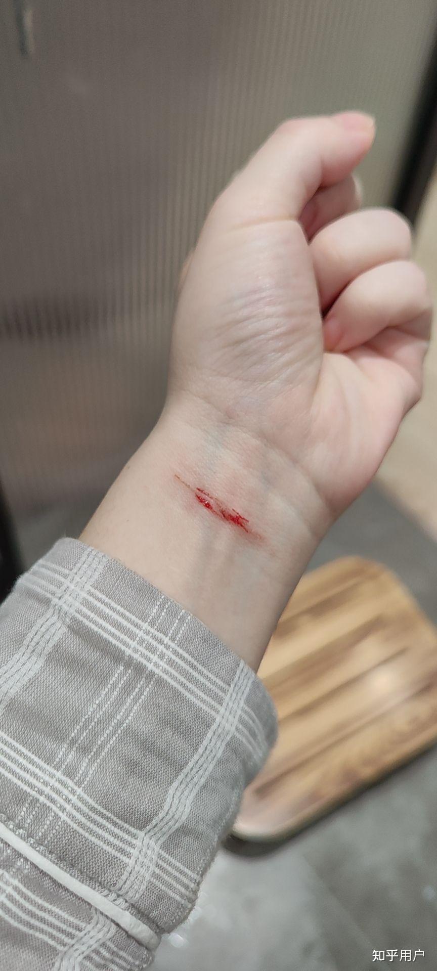 割腕自残的心理障碍患者一般有怎样的心理动机实际实践时有什么感受和