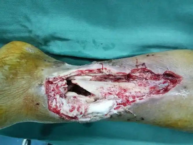 清创外固定架 vsd负压吸引技术治疗一例开放骨折后踝部严重感染老年